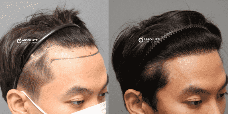 ปลูกผม FUT hair transplant Thailand