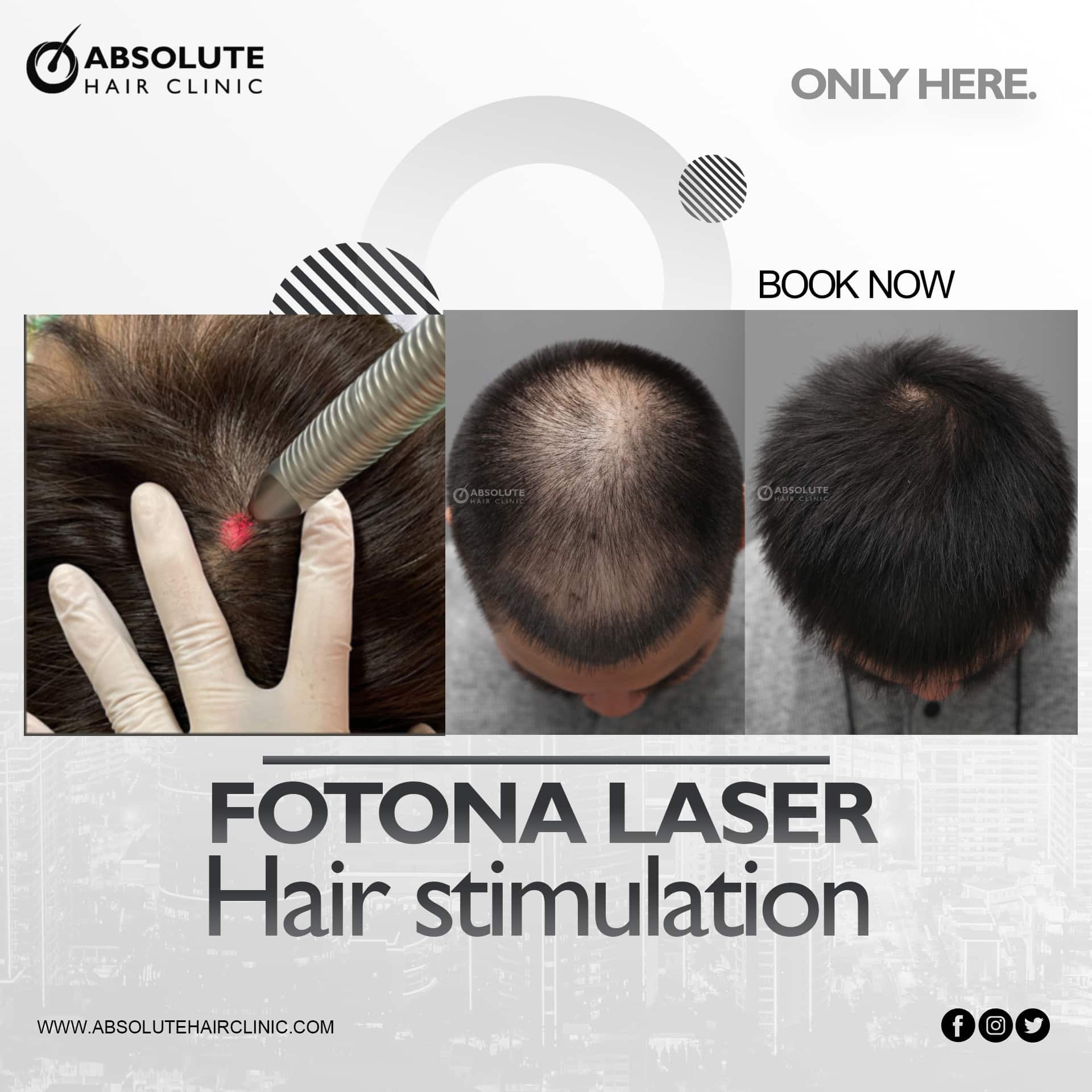 Botanik I Deqenereret Fotona SP Dynamis Laser for hair loss - Absolute hair clinic