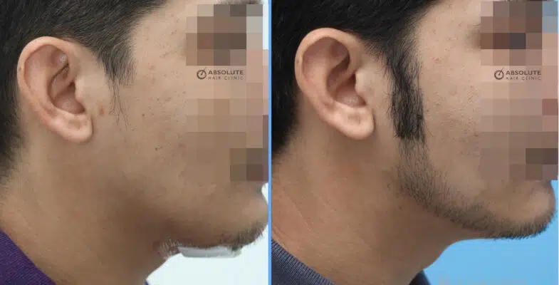 ปลูกหนวดเครา beard hair transplant Thailand
