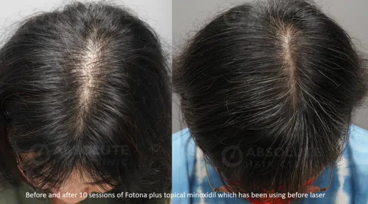 โฟโตนาเลเซอร์ ผมบางFotona laser hair loss Absolute Hair Clinic