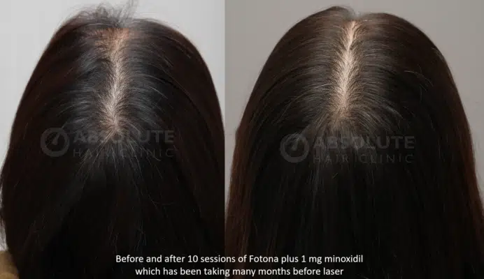 Fotona laser hair loss