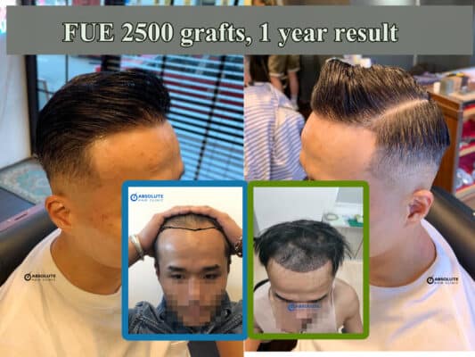 ปลูกผม FUE hair transplant Thailand Absolute hair clinic