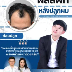 รีวิวปลูกผม FUE hair transplant Thailand Absolute hair clinic