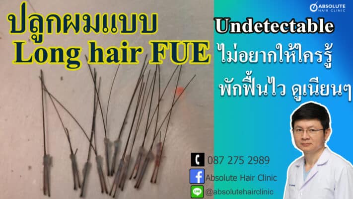 ปลูกผม long hair FUE hair transplant Thailand Absolute hair clinic