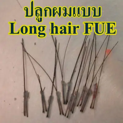 ปลูกผม long hair FUE hair transplant Thailand Absolute hair clinic