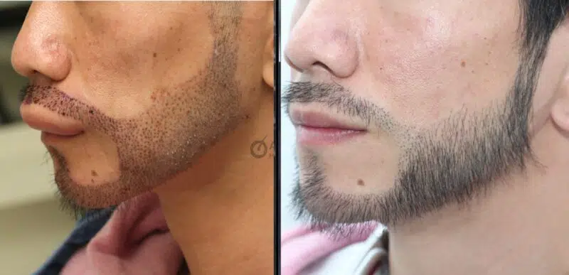 ปลูกหนวดเครา beard hair transplant Thailand