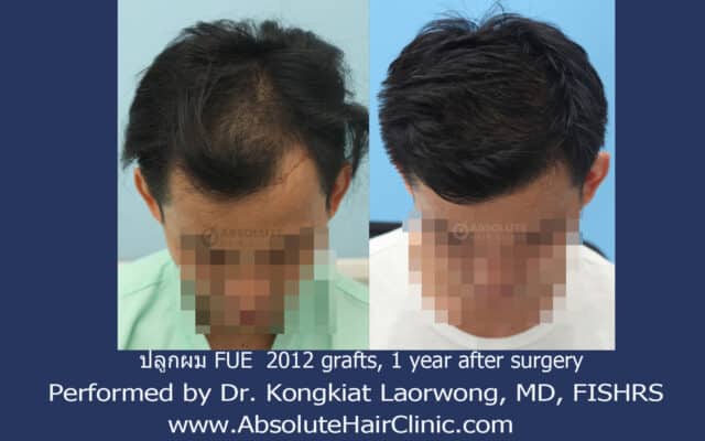 ปลูกผม FUE hair transplant Thailand Absolute hair clinic