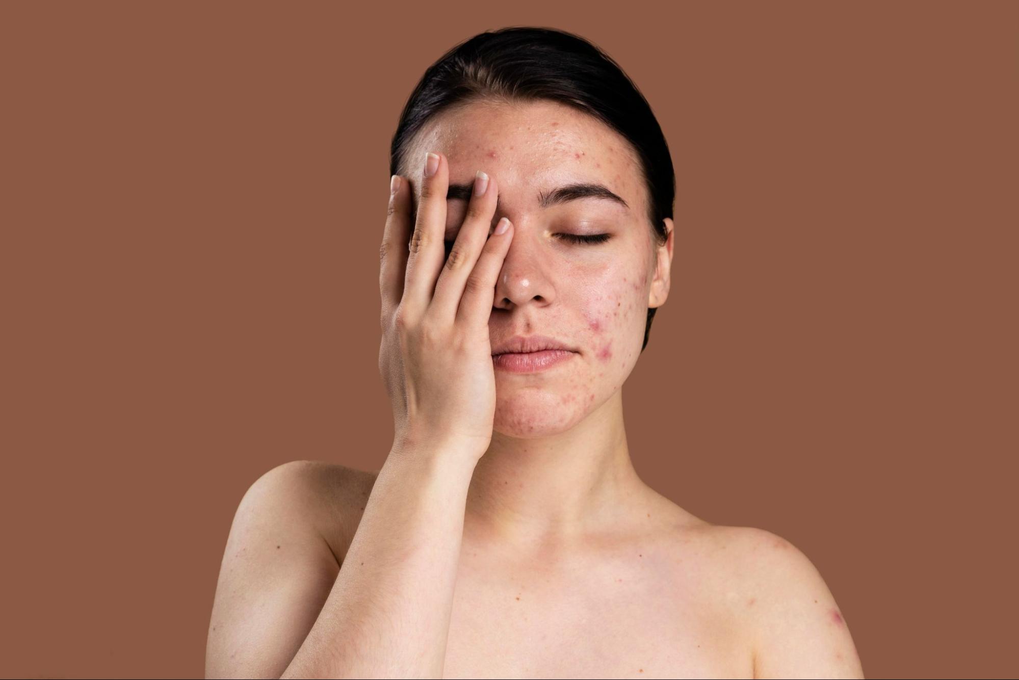 ผื่นภูมิแพ้ที่หน้า เซ็บเดิร์มที่หน้า Facial Seborrheic Dermatitis 