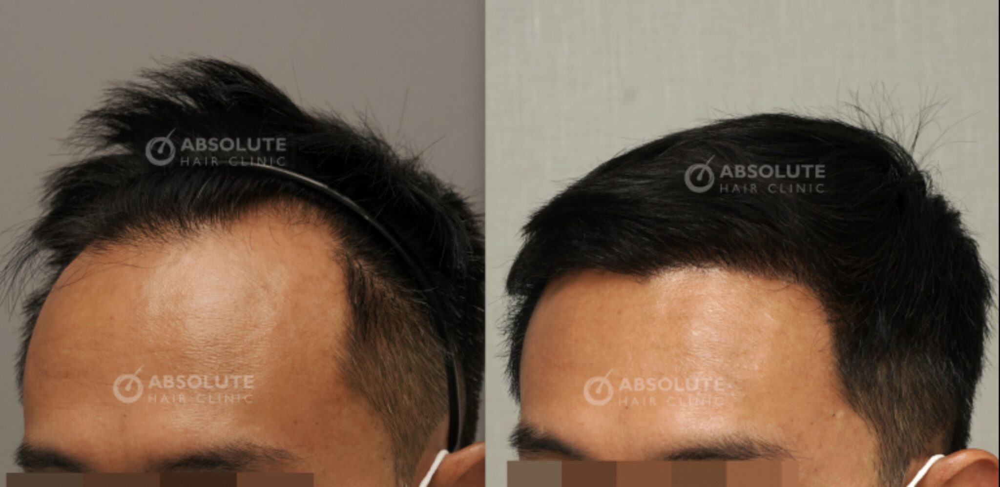 Temporal Point Temporal Points Hair Restoration - Absolute hair clinic